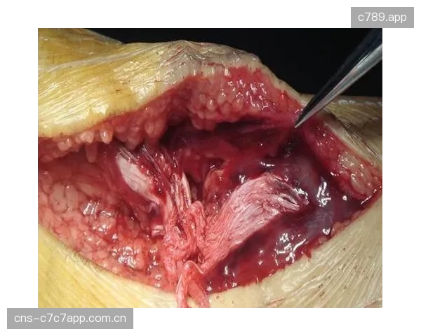 北体大运动医学中心正式启动“自体肌腱细胞+3D生物支架”临床研究，专门处理跟腱断裂后的组织再生难题